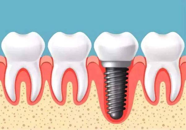 一颗种植牙要多少钱（一颗种植牙约6000元）