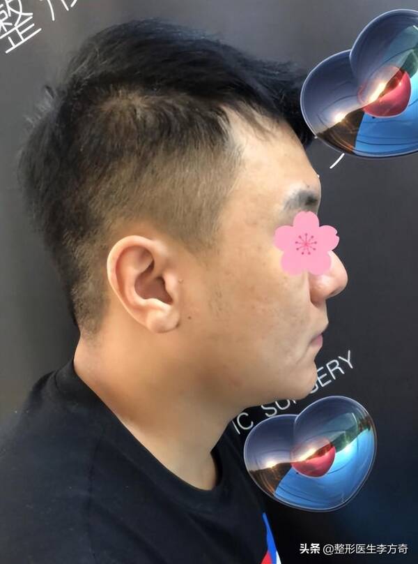 晶体下巴做完是硬的吗？29岁男士爱美填充下巴，导致红肿歪斜！下巴微晶瓷取出记录