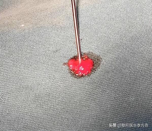 晶体下巴做完是硬的吗？29岁男士爱美填充下巴，导致红肿歪斜！下巴微晶瓷取出记录