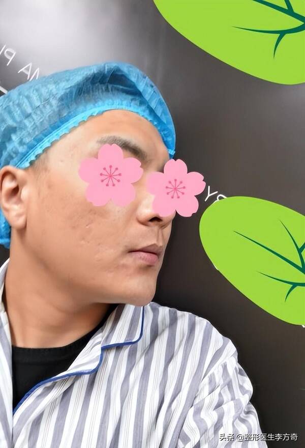 晶体下巴做完是硬的吗？29岁男士爱美填充下巴，导致红肿歪斜！下巴微晶瓷取出记录
