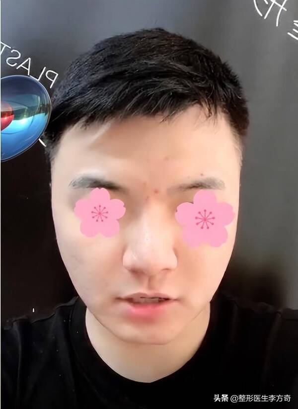 晶体下巴做完是硬的吗？29岁男士爱美填充下巴，导致红肿歪斜！下巴微晶瓷取出记录