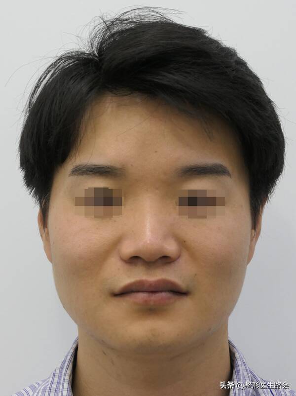 整容鼻孔外翻，30岁南京小伙做全鼻+下巴改造，短短6个月“变脸比翻书还快”？