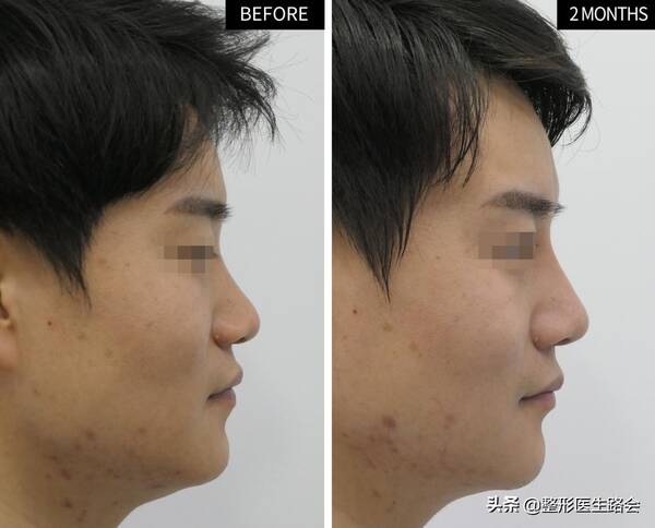 整容鼻孔外翻，30岁南京小伙做全鼻+下巴改造，短短6个月“变脸比翻书还快”？