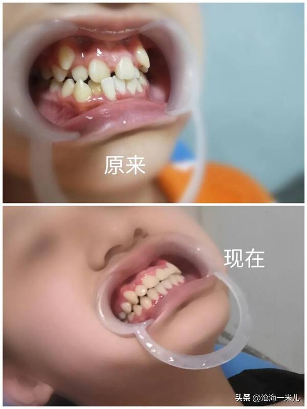 我带着几万块的牙套？花费4000元，戴了2年的牙套，拯救了儿子一口歪七扭八的牙齿