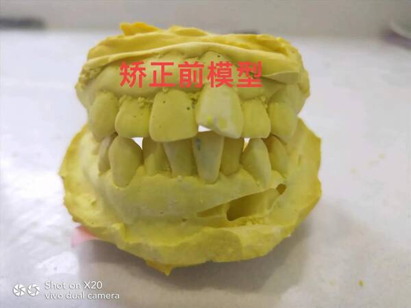 牙套矫正牙齿大概多少钱，牙齿矫正花费了多少钱呢？矫正前后对比
