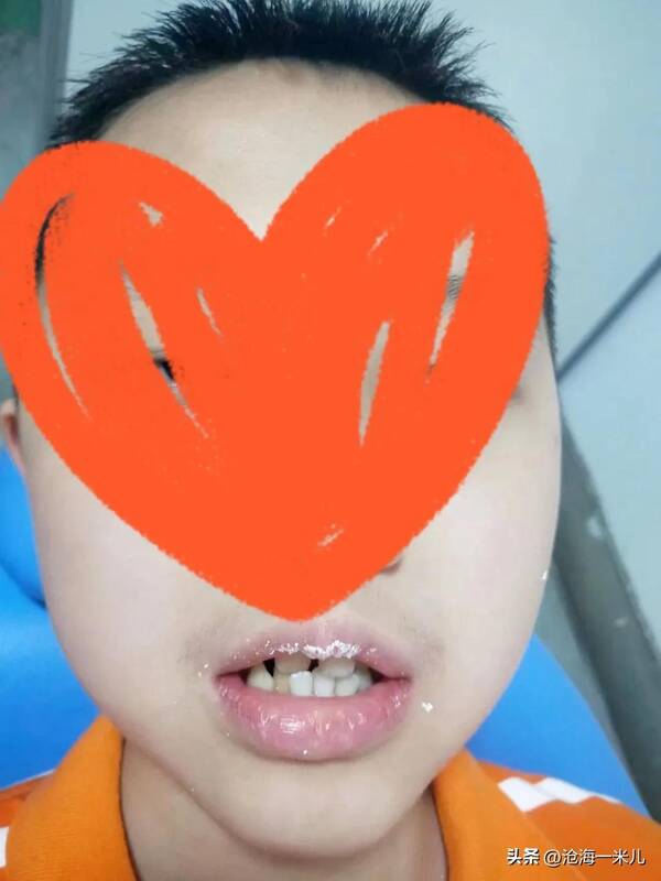 我带着几万块的牙套？花费4000元，戴了2年的牙套，拯救了儿子一口歪七扭八的牙齿