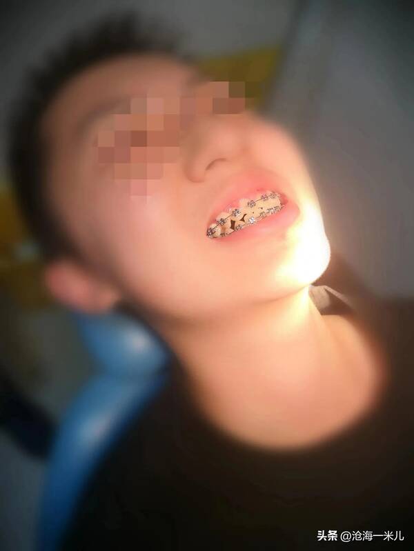 我带着几万块的牙套？花费4000元，戴了2年的牙套，拯救了儿子一口歪七扭八的牙齿