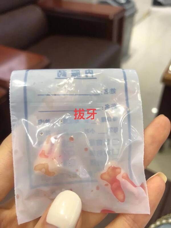 牙套矫正牙齿大概多少钱，牙齿矫正花费了多少钱呢？矫正前后对比