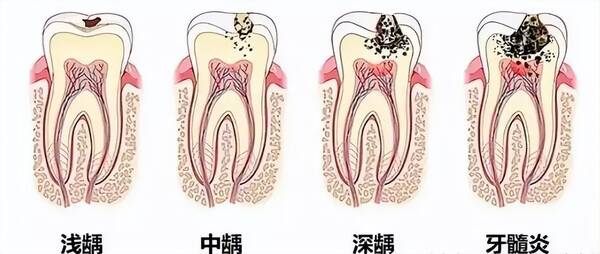 补牙价格差异为何这么大？揭秘你不知道的补牙秘密？补牙价格差异如此巨大，你不知道的看牙“黑幕”全都在这里