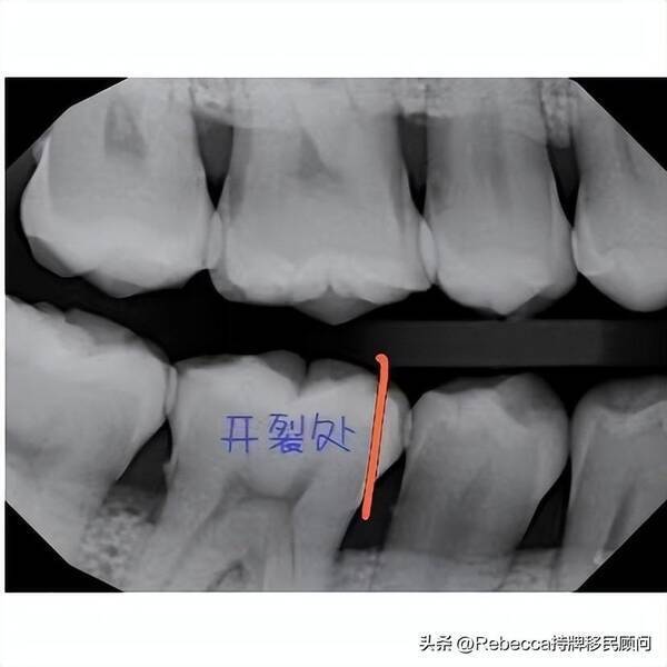 加拿大牙医保险怎么买？在加拿大没有保险洗牙补牙大概需要花多少钱？