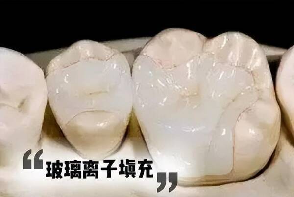 补牙价格差异为何这么大？揭秘你不知道的补牙秘密？补牙价格差异如此巨大，你不知道的看牙“黑幕”全都在这里