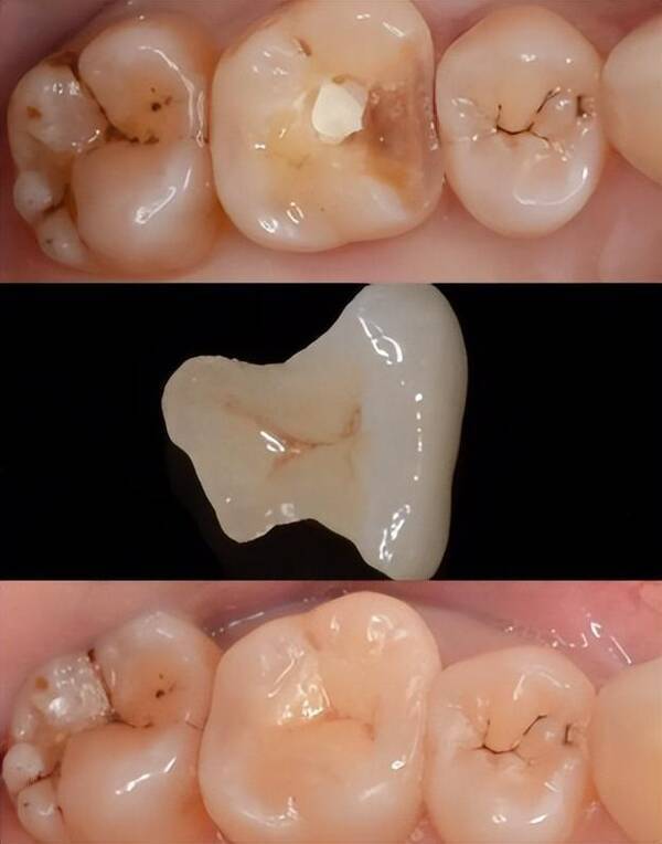 临床常用的补牙材料主要有以下几种:1,银汞合金:银汞合金是传统的补牙