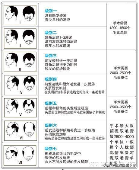 植发安全吗百度知道？植发避坑指南之植发技术与价格全科普｜|三甲医院植发医生李宁