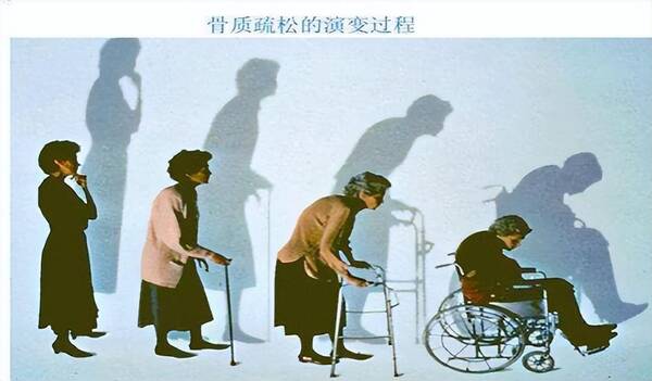 醋会让骨头疏松吗？这“2物”或比醋还伤骨，提醒大家：不想骨骼变脆弱，尽量少吃