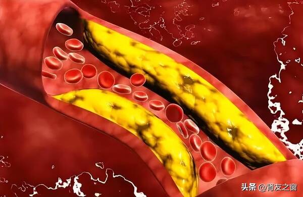 刺梨根可以治糖尿病吗？糖尿病刺梨