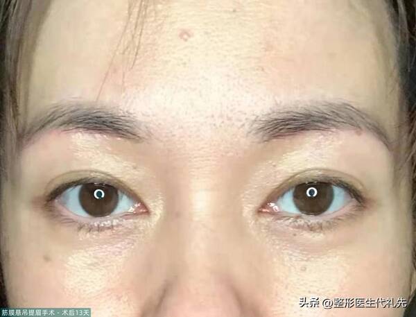 提眉手术可以保持几年48岁？49岁女士做提眉手术，术前，术后恢复过程，术后13天高清对比