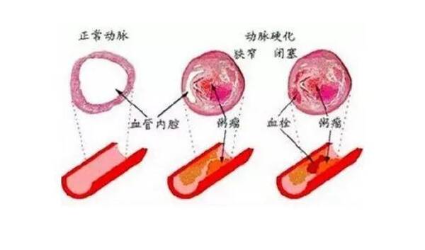 主要就是抑制血管內皮細胞的增生,減少血管內支架再狹窄