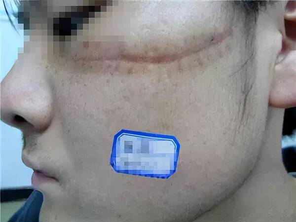 郑州第二中医院祛疤效果怎么样？郑州市第二中医院疤痕诊疗中心
