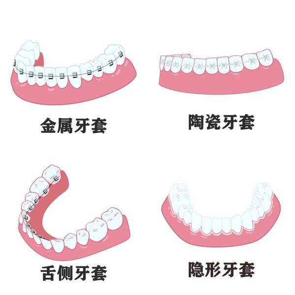 牙套几种类型？牙套种类知多少