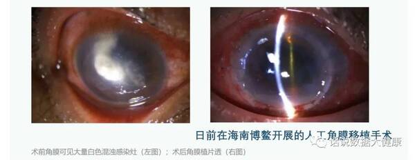 视网膜脱落失明可以治愈吗？让20名失明患者全部恢复了视力，这是一种怎样的新型廉价角膜？