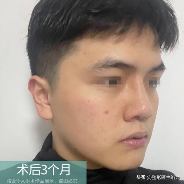 北京做鼻子多少钱，花几万到北京做鼻子，真的值吗？术后10个月，谈谈我的感受