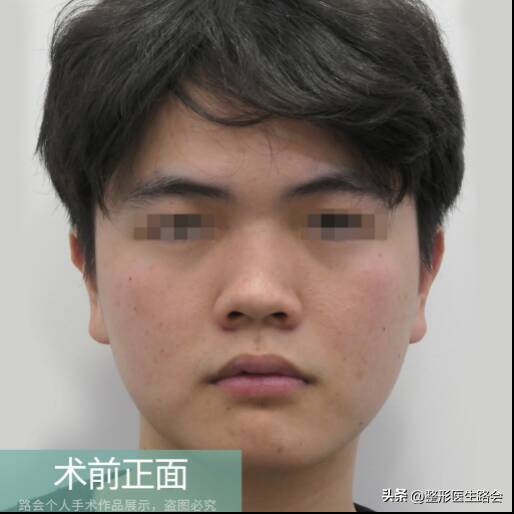 北京做鼻子多少钱，花几万到北京做鼻子，真的值吗？术后10个月，谈谈我的感受