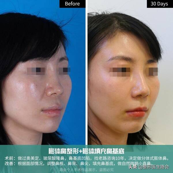 玻尿酸隆鼻后没那么挺了?玻尿酸隆鼻后遗症曝光,就我敢说实话! 玻尿酸隆鼻后没那么挺了?玻尿酸隆鼻后遗症曝光,就我敢说实话!