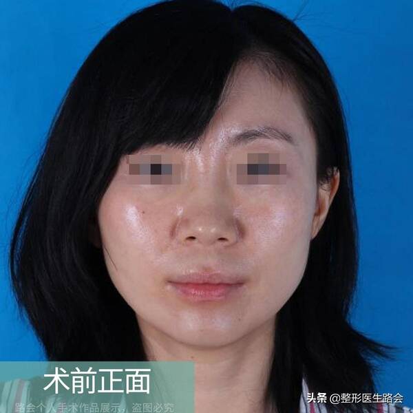 玻尿酸隆鼻后没那么挺了?玻尿酸隆鼻后遗症曝光,就我敢说实话! 玻尿酸隆鼻后没那么挺了?玻尿酸隆鼻后遗症曝光,就我敢说实话!