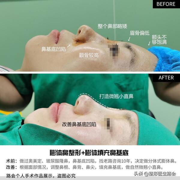 玻尿酸隆鼻后没那么挺了?玻尿酸隆鼻后遗症曝光,就我敢说实话! 玻尿酸隆鼻后没那么挺了?玻尿酸隆鼻后遗症曝光,就我敢说实话!
