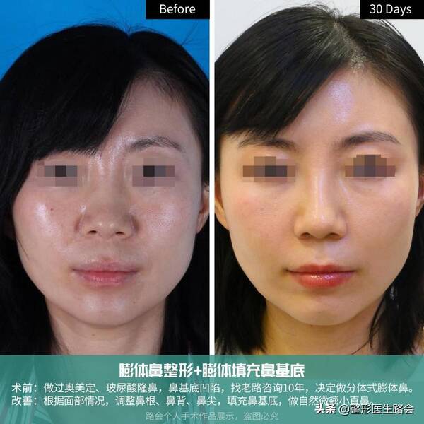 玻尿酸隆鼻后没那么挺了?玻尿酸隆鼻后遗症曝光,就我敢说实话! 玻尿酸隆鼻后没那么挺了?玻尿酸隆鼻后遗症曝光,就我敢说实话!
