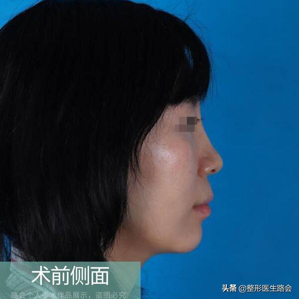 玻尿酸隆鼻后没那么挺了?玻尿酸隆鼻后遗症曝光,就我敢说实话! 玻尿酸隆鼻后没那么挺了?玻尿酸隆鼻后遗症曝光,就我敢说实话!