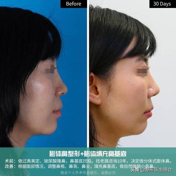 玻尿酸隆鼻后没那么挺了?玻尿酸隆鼻后遗症曝光,就我敢说实话! 玻尿酸隆鼻后没那么挺了?玻尿酸隆鼻后遗症曝光,就我敢说实话!