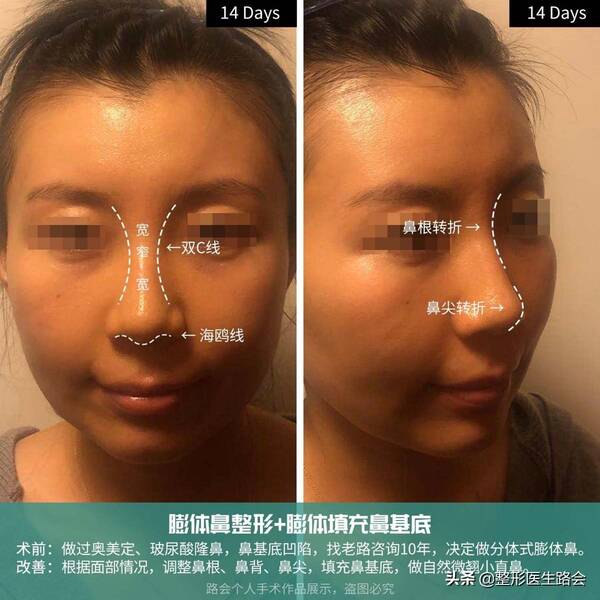 玻尿酸隆鼻后没那么挺了?玻尿酸隆鼻后遗症曝光,就我敢说实话! 玻尿酸隆鼻后没那么挺了?玻尿酸隆鼻后遗症曝光,就我敢说实话!