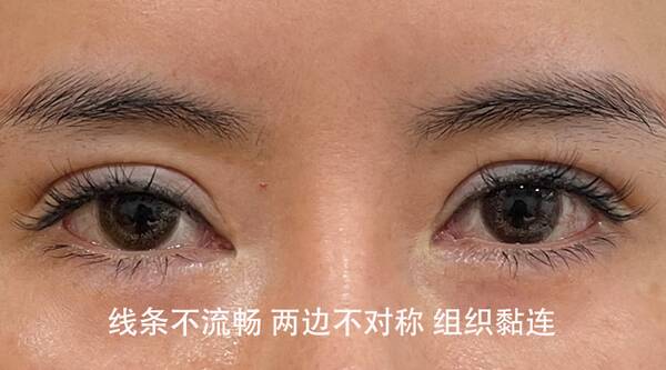 做双眼皮开眼角术后注意事项,一般开眼角和做双眼皮多少钱 做双眼皮开眼角术后注意事项,一般开眼角和做双眼皮多少钱