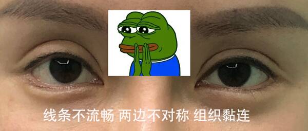 做双眼皮开眼角术后注意事项,一般开眼角和做双眼皮多少钱 做双眼皮开眼角术后注意事项,一般开眼角和做双眼皮多少钱