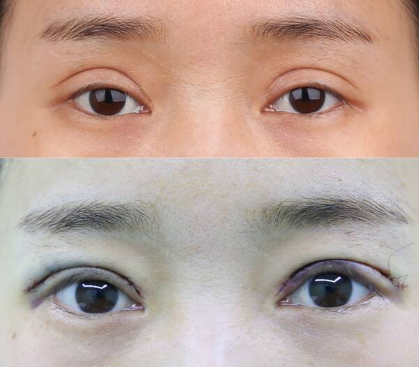 做双眼皮开眼角术后注意事项,一般开眼角和做双眼皮多少钱 做双眼皮开眼角术后注意事项,一般开眼角和做双眼皮多少钱