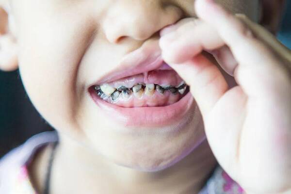 5岁靠前磨牙长蛀牙了，不到5岁烂了12颗牙，花费2万多！忽略这4件事，天天刷牙也长蛀牙