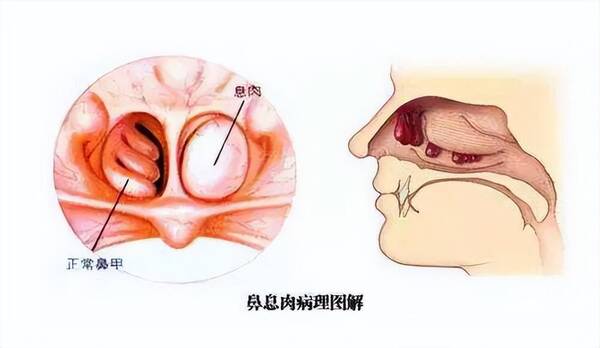 鼻息肉是什么样子的图片