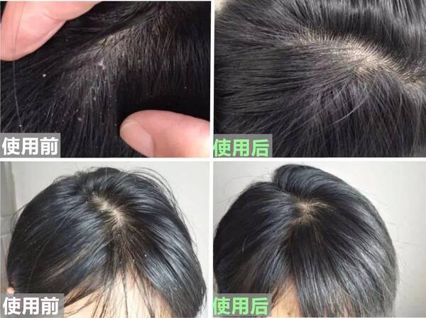 去屑洗发水康王，北京协和医院去屑洗发水怎么样？