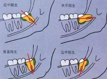 智齿发炎一般几天能好？智齿发炎痛一定要拔吗？