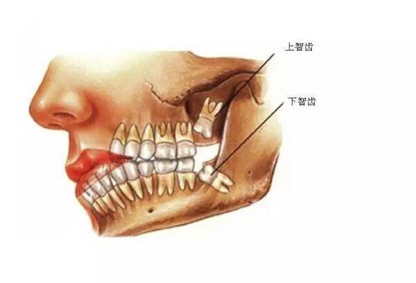 智齿发炎一般几天能好？智齿发炎痛一定要拔吗？