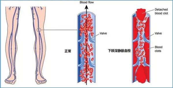 梯度压力弹力袜，抗血栓梯度压力袜的原理是什么？