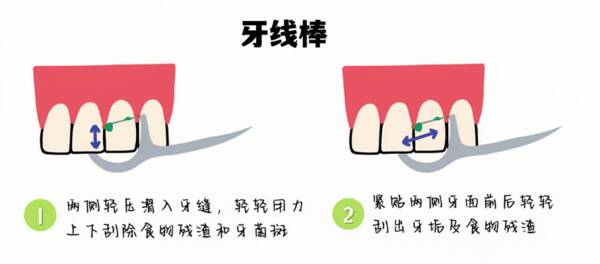 牙菌斑对牙周组织的影响，【口腔健康系列科普】让牙间隙菌斑无处遁形