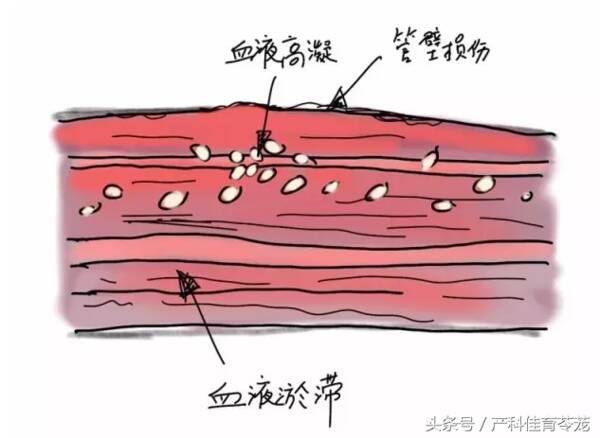 孕妇为什么要穿弹力袜？孕妇穿弹力袜有用吗？